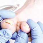What is the remedy/cure for a whitlow (or paronychia) problem?