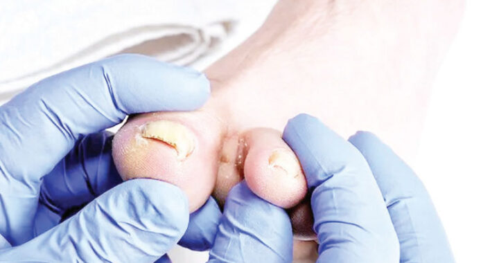 What is the remedy/cure for a whitlow (or paronychia) problem?