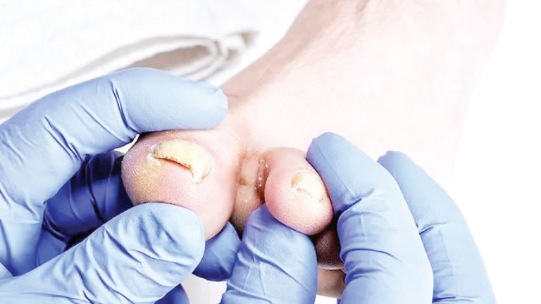 What is the remedy/cure for a whitlow (or paronychia) problem?